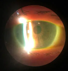 Example of a DMEK patient after surgery with Dr. Tai