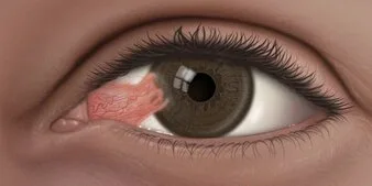 Eye with pterygium growth on the conjunctiva